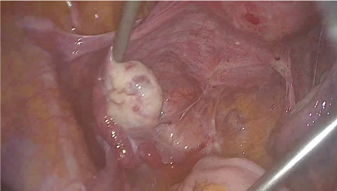 Visão geral inicial - Ovários fixos, lesão retrocervical, intestinal e de ligamento uterossacro.
