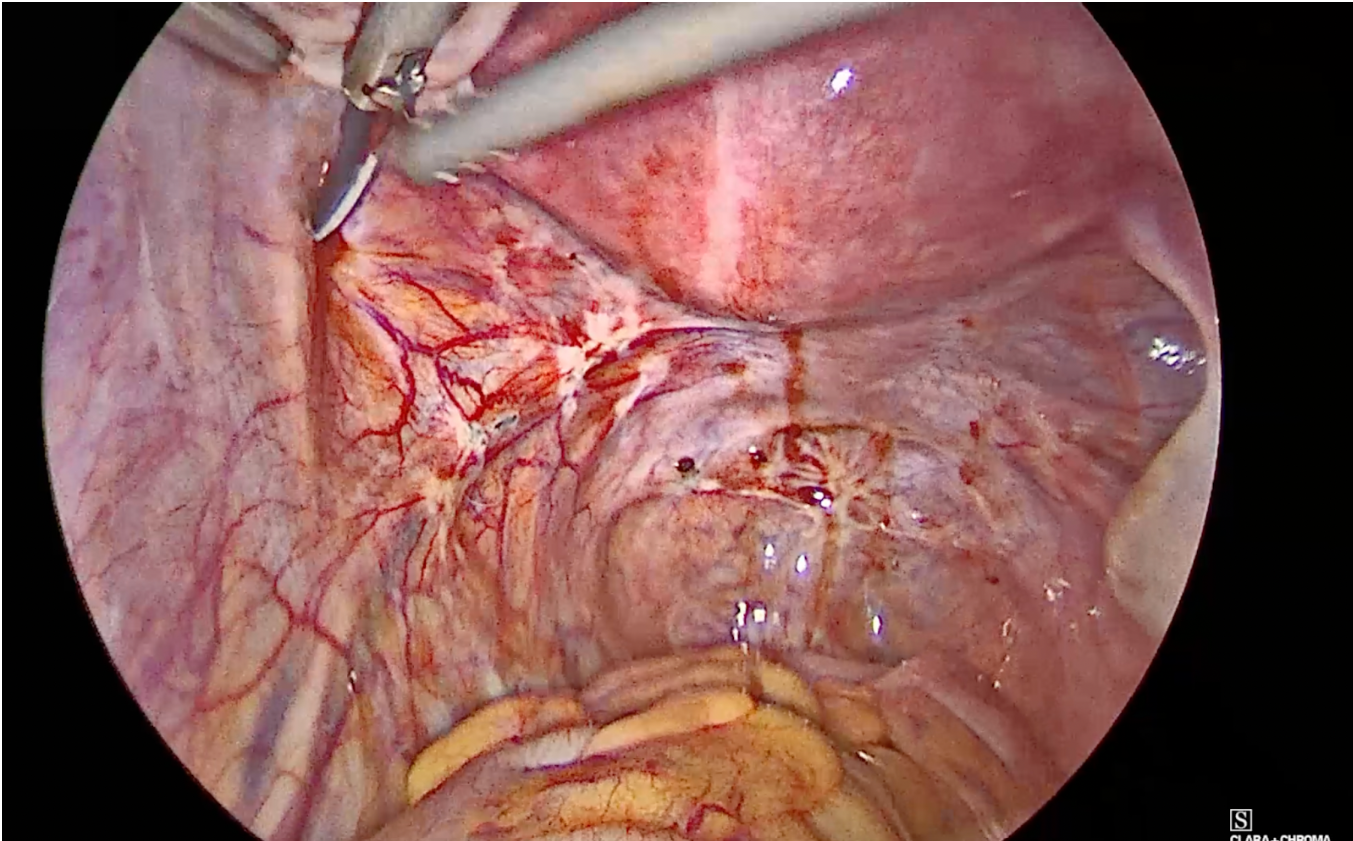 Focos de endometriose em fosseta ovariano esquerda, Paracervical esquerda, Ureter esquerda, pararretal esquerda, retossigmoide e retrocervical. Especialista em Endometriose em SP.