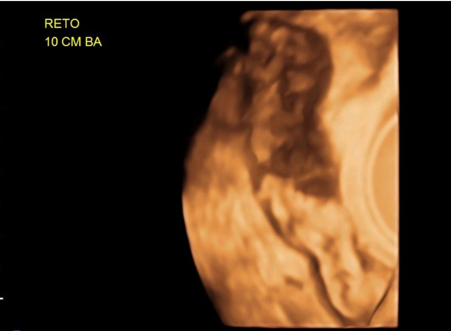 Ressonância Magnética (RM) Endometriose