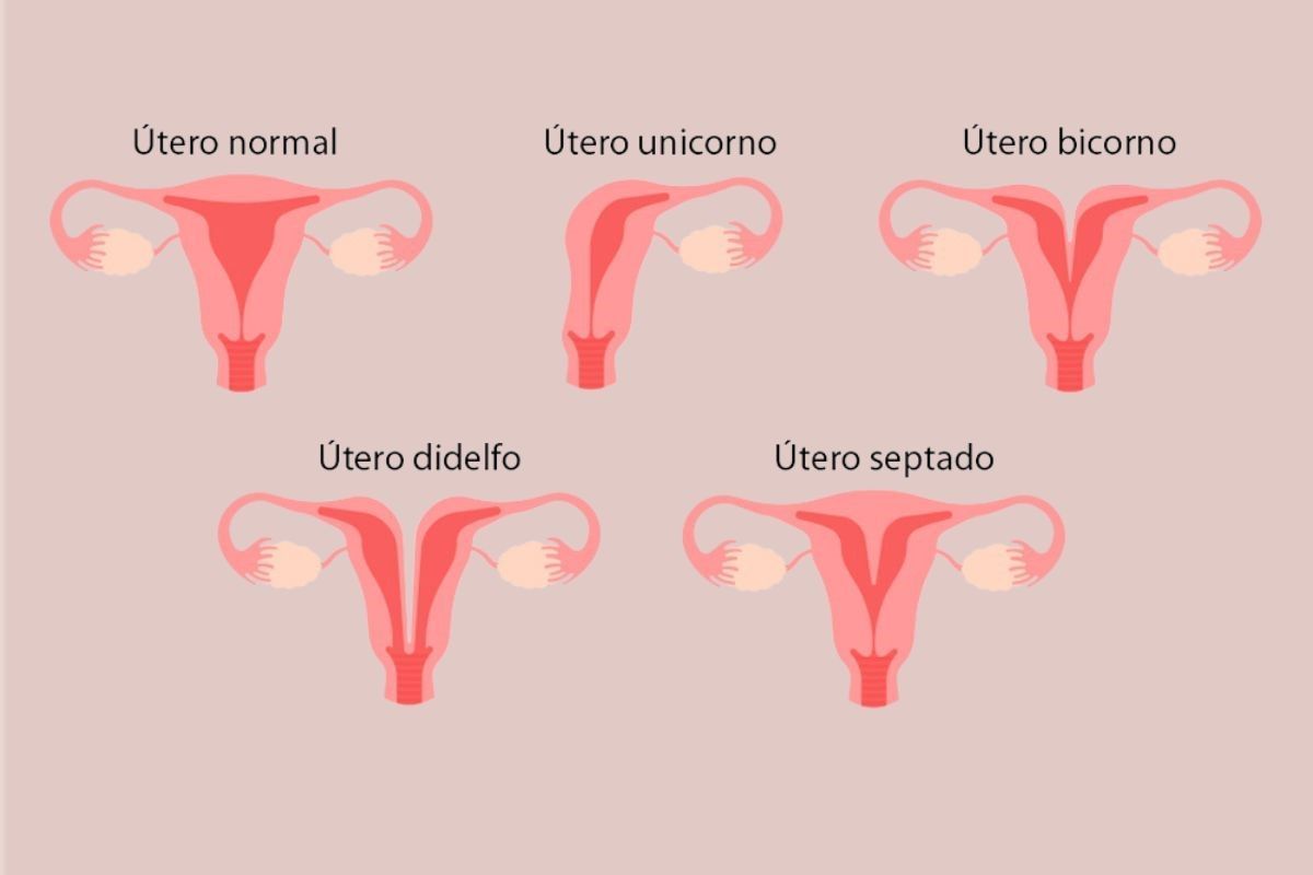 tipos-de-malformacao-uterina-dra-graziele-cervantes-ginecologista-sao-paulo