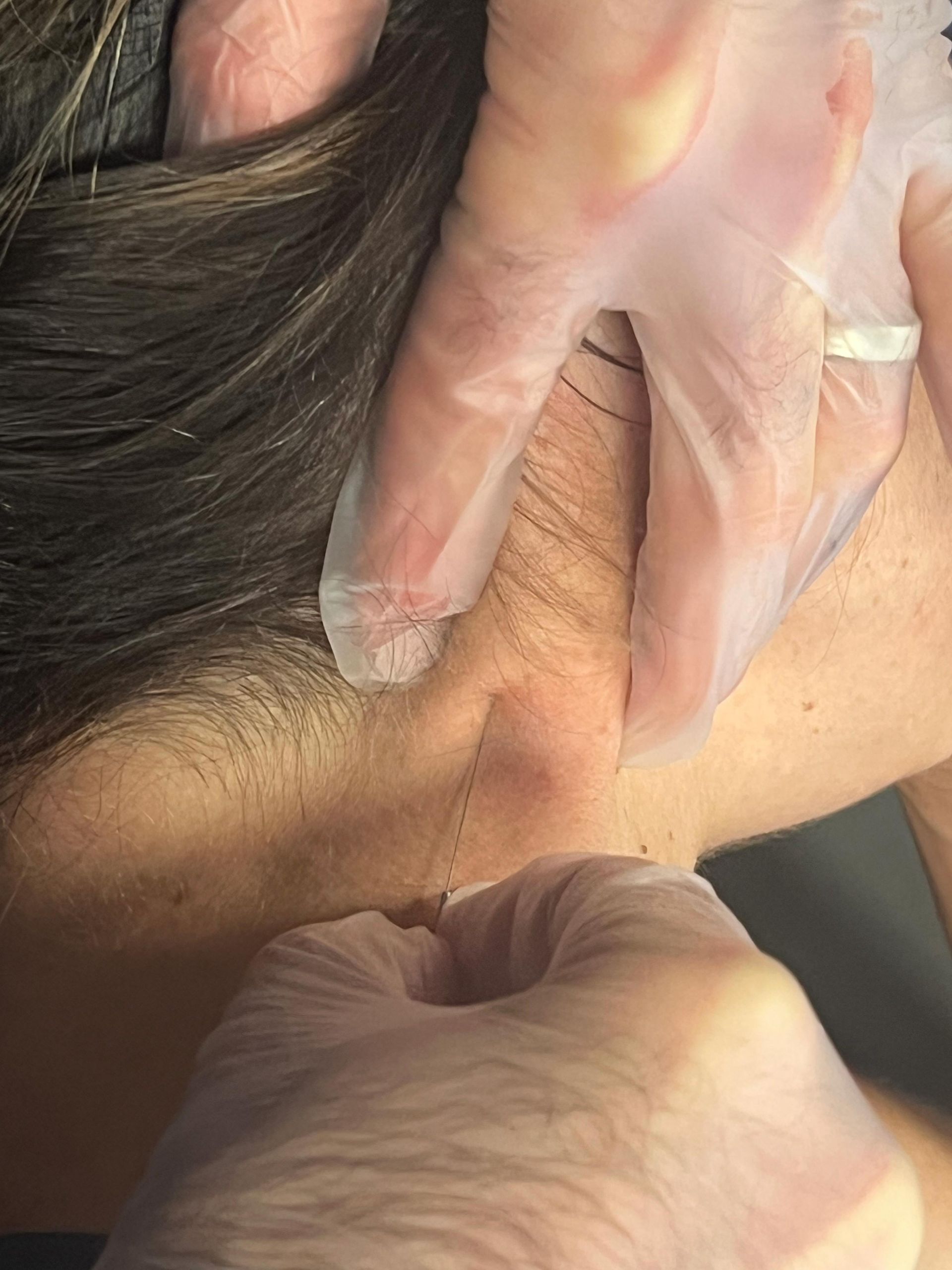 Hand Injecting A Needle Into A Neck - Chicago, IL - Fast Track Physio