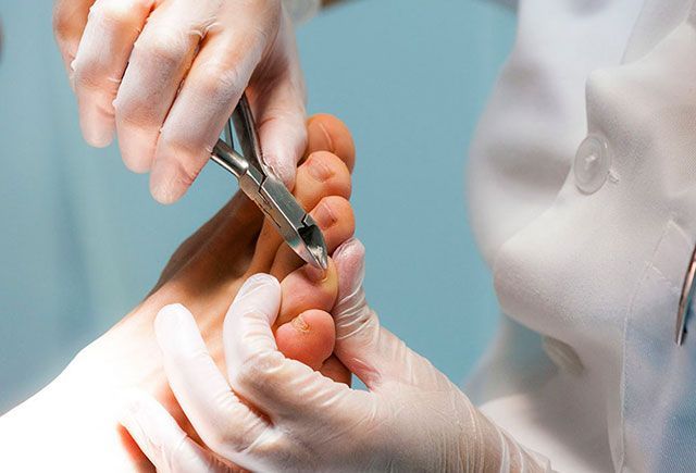 Un médico está cortando las uñas de los pies de un paciente con unas tijeras.