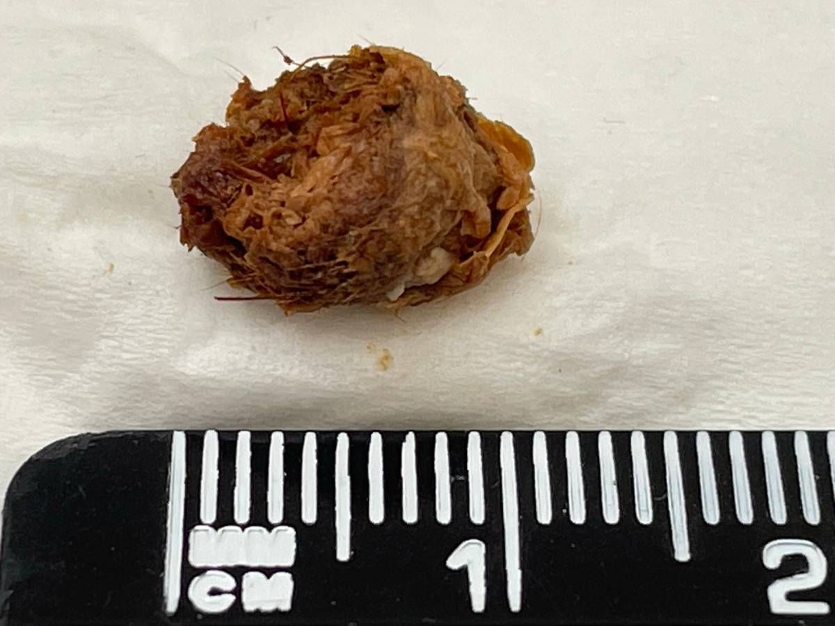 Ear wax removed following irrigation and olive oil spraying