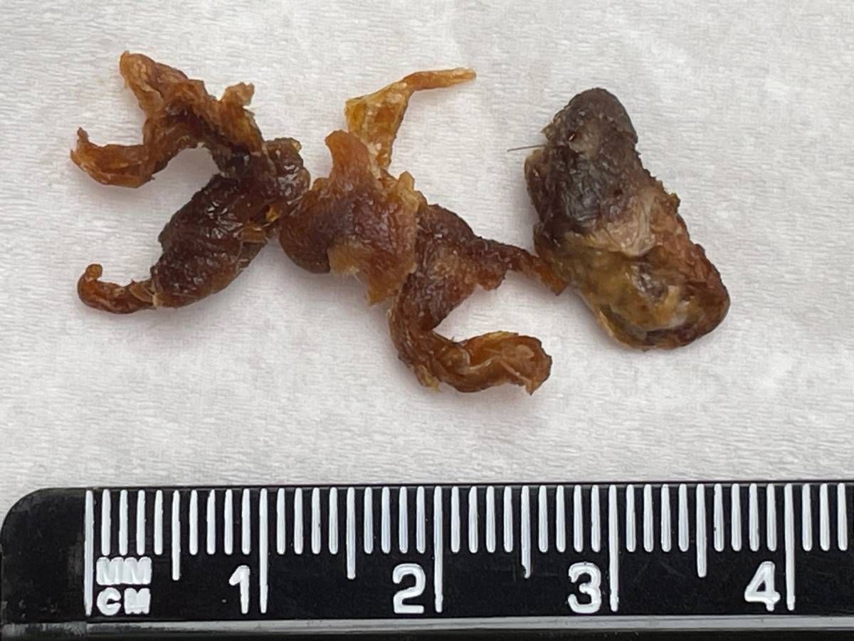 Happy Ears Ear Wax Removal Nottingham - wax removed from both ears using microsuction