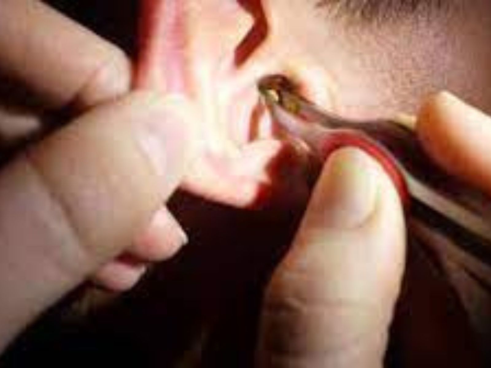Manual Ear Wax removal for patient from Arnold