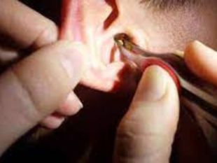 Manual Ear Wax Removal