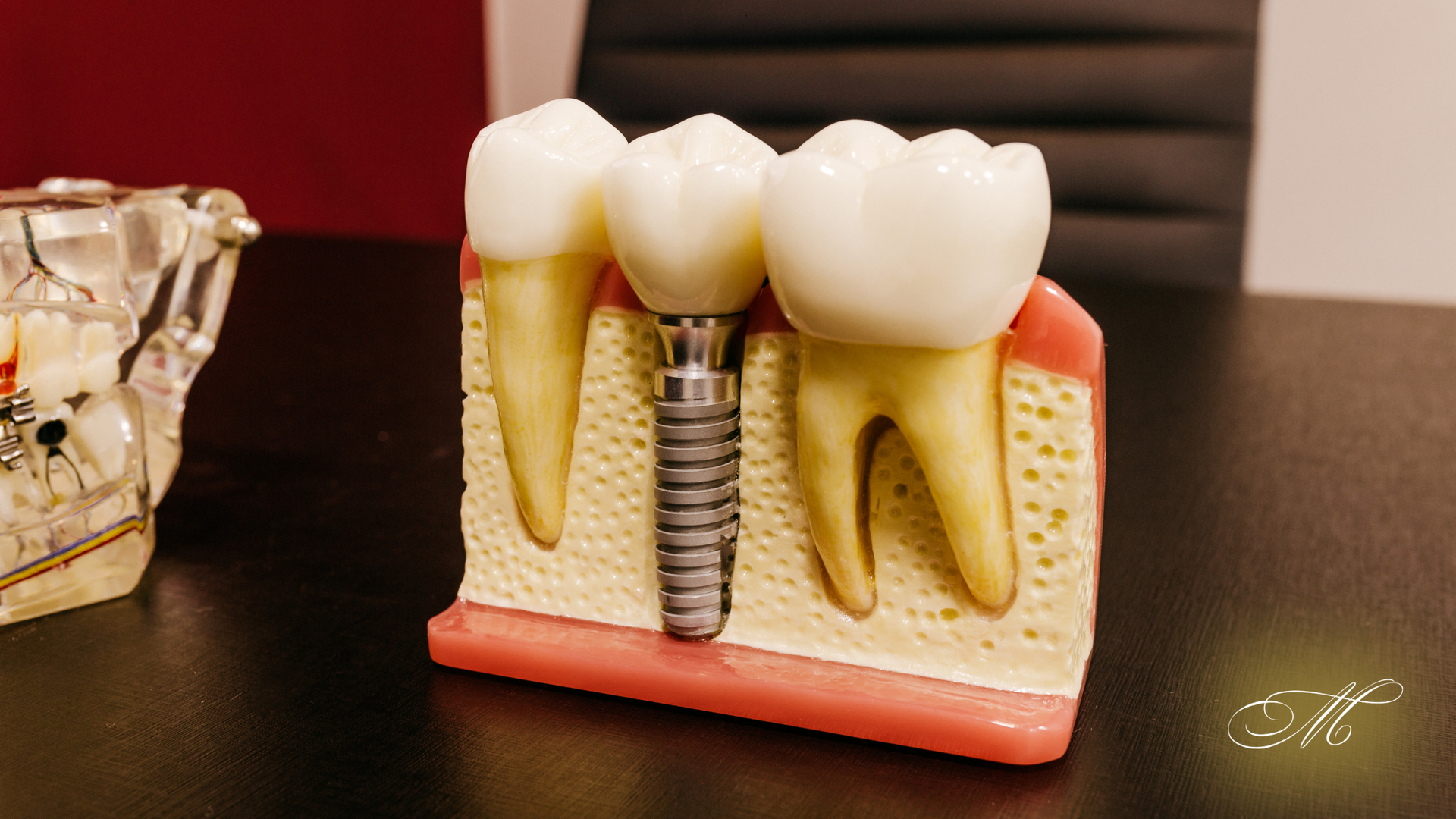 Model of teeth with an implant, showing bone structure and prosthetic crowns.