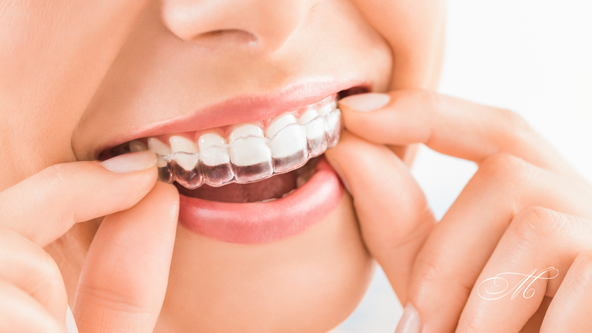 A woman is putting invisible braces on her teeth.