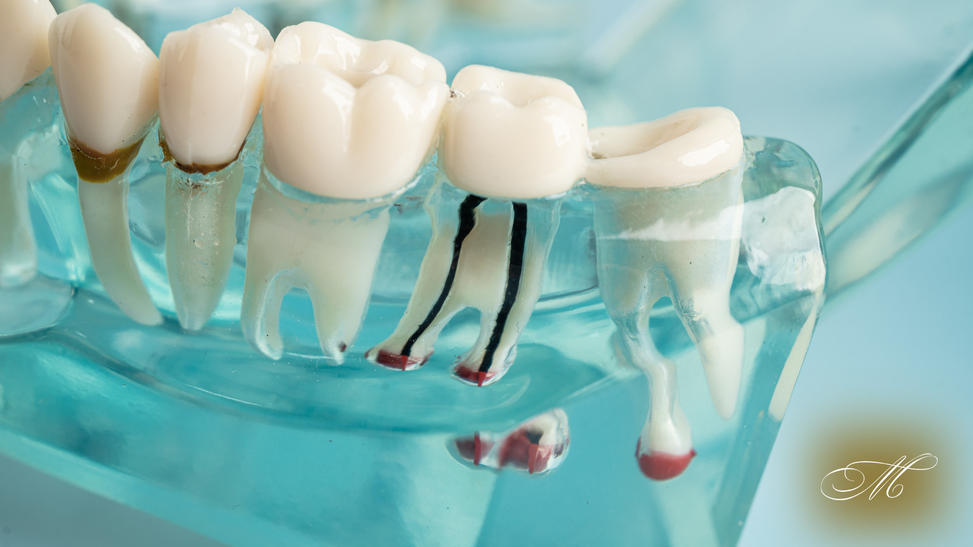 Dental model showing teeth with exposed roots and root canal treatments.