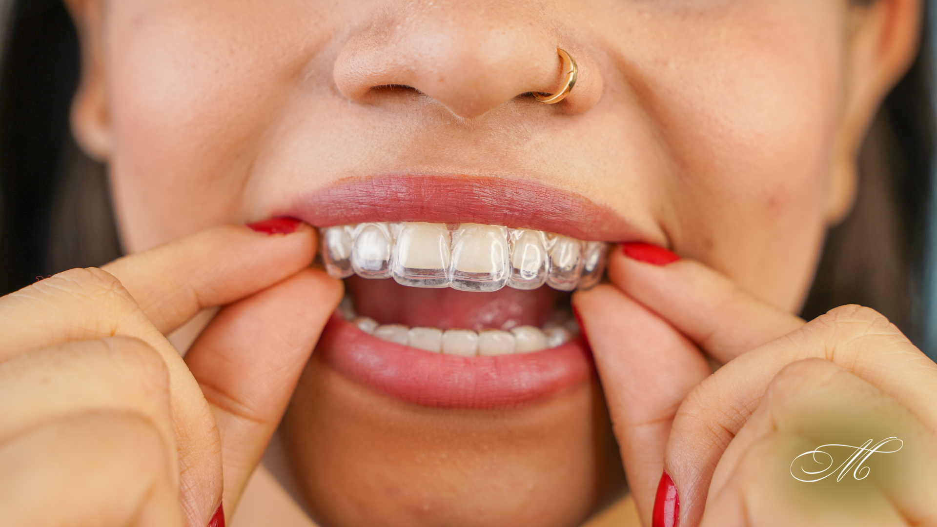 A person showing clear aligners in their mouth, holding them with both hands.