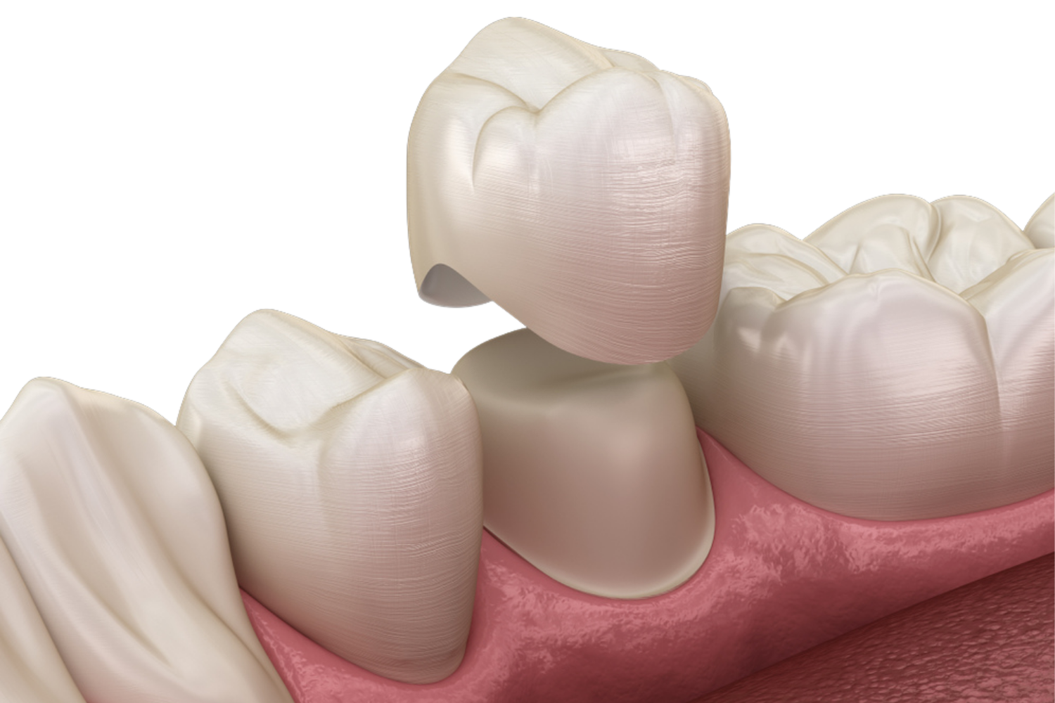A 3D dental illustration showing a white tooth crown being placed over a prepared tooth in the lower gum line.