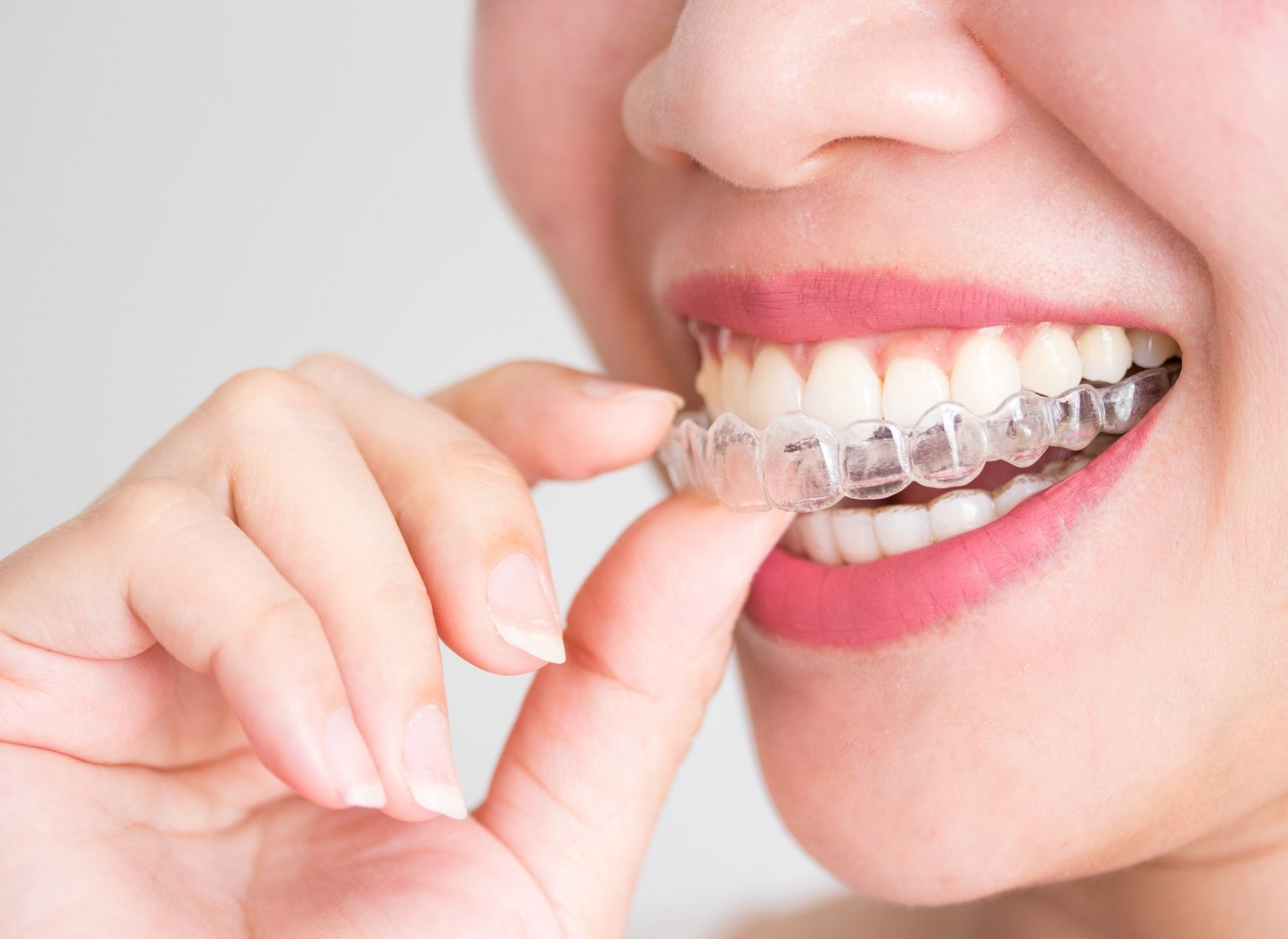 A person inserts a clear dental aligner tray onto their upper teeth using their fingers.