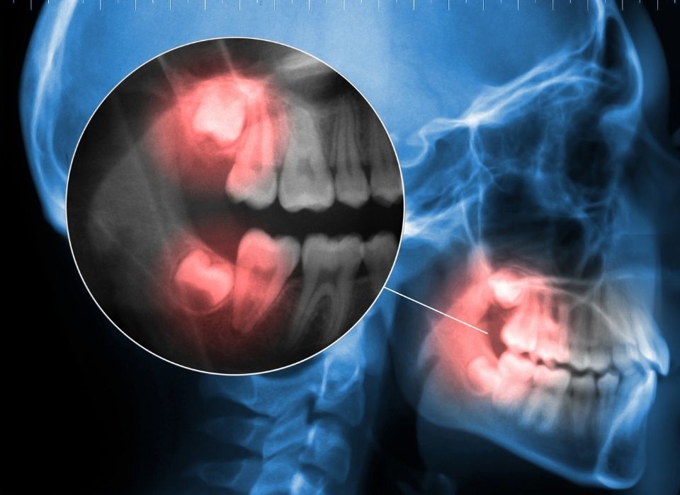 A side-view skull X-ray with a magnified circle highlighting impacted wisdom teeth in the upper and lower jaws.