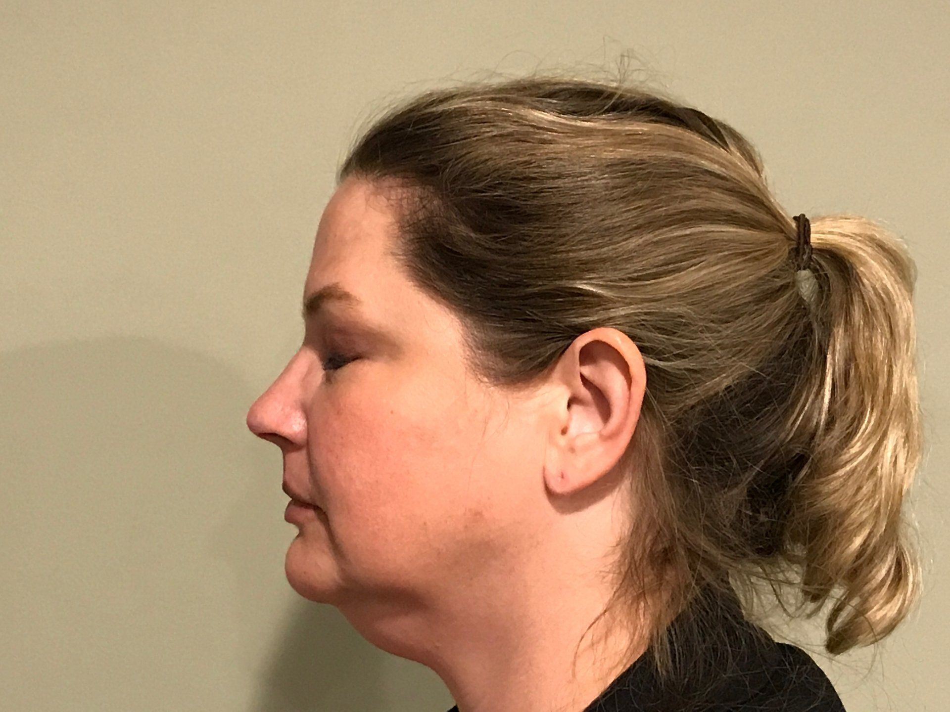 Patient Before Accutite