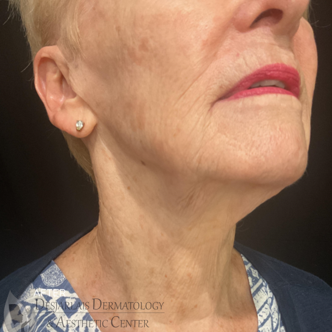 ellacor micro-coring After Image at Dr. Desjarlais' Office in Adrian, MI