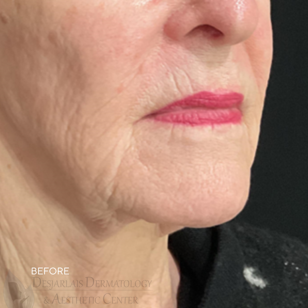 ellacor micro-coring Before Image at Dr. Desjarlais' Office in Adrian, MI