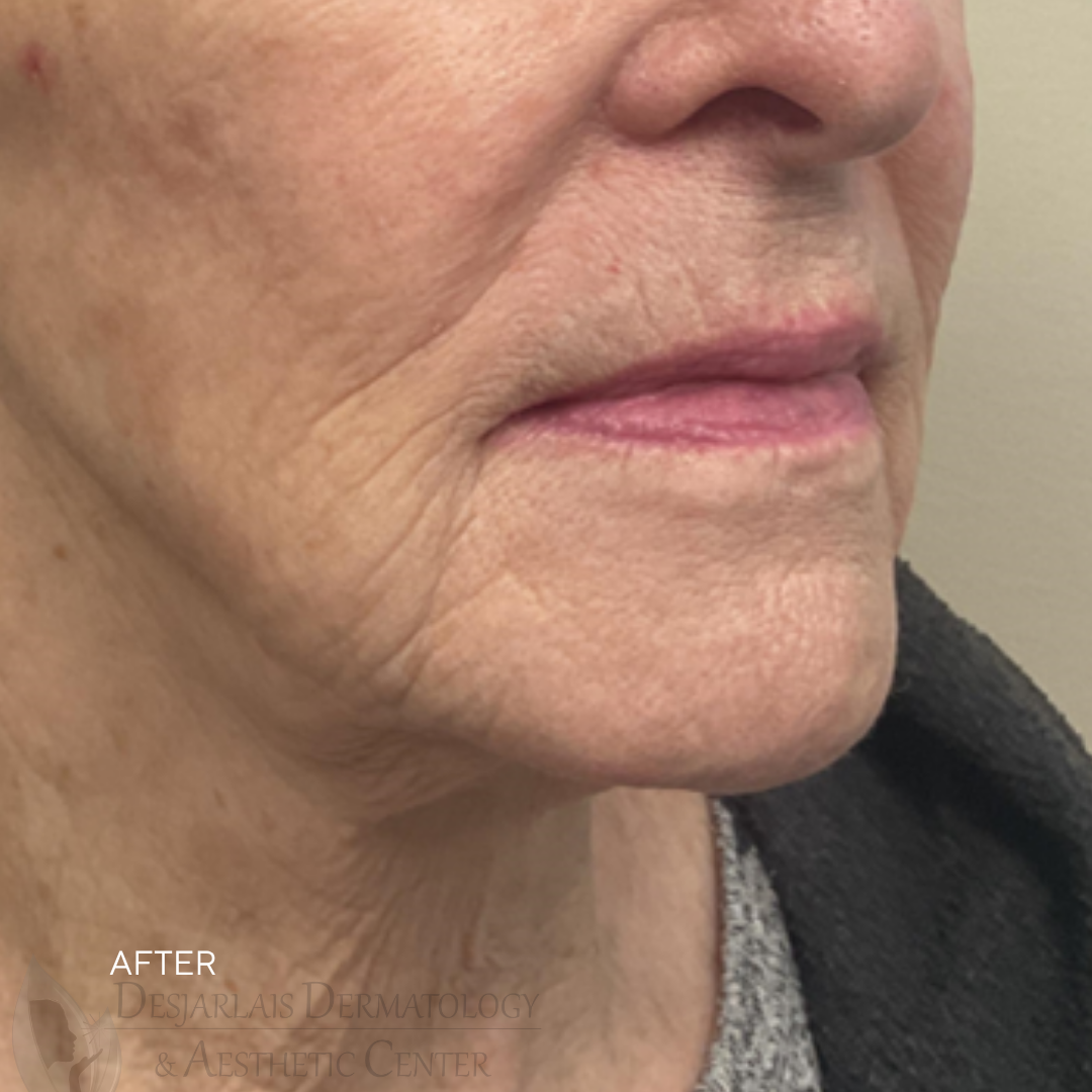 ellacor micro-coring After Image at Dr. Desjarlais' Office in Adrian, MI