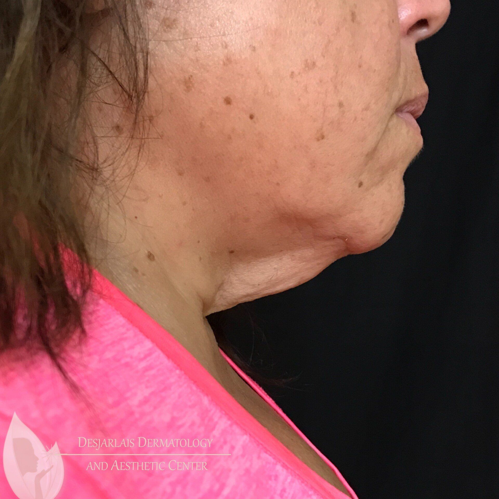 AccuTite Before Image at Dr. Desjarlais' Office in Adrian, MI