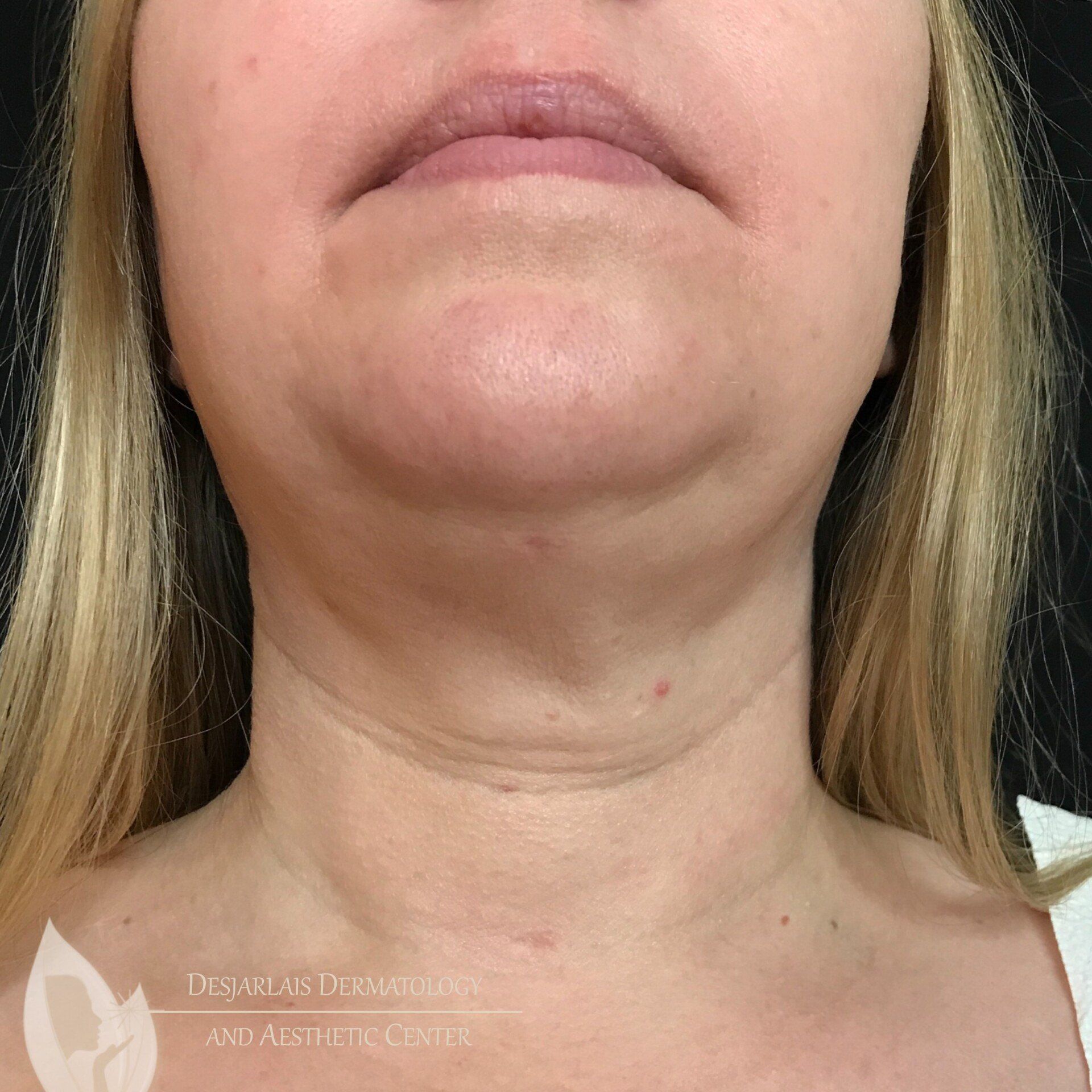 FaceTite After Image at Dr. Desjarlais' Office in Adrian, MI