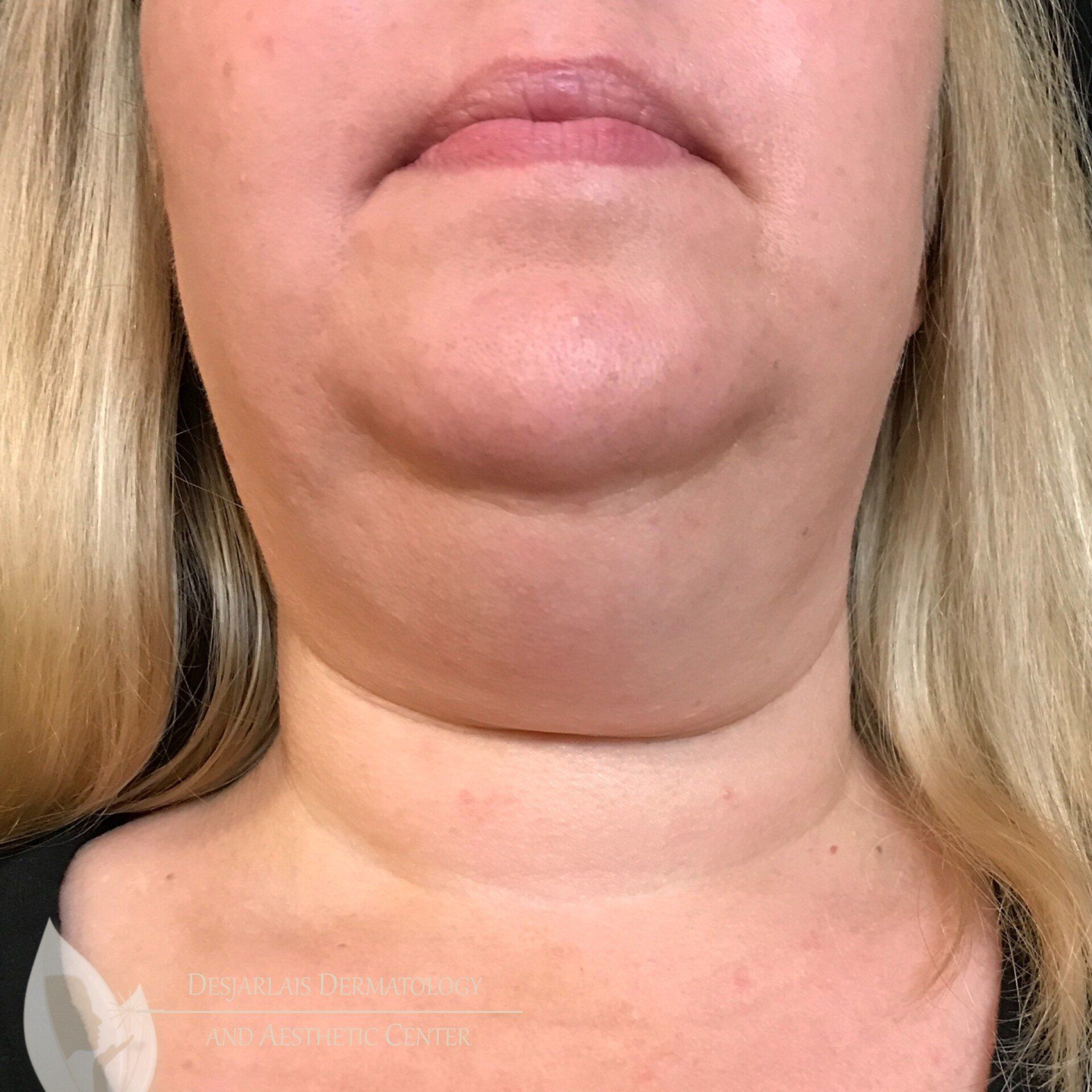 FaceTite Before Image at Dr. Desjarlais' Office in Adrian, MI