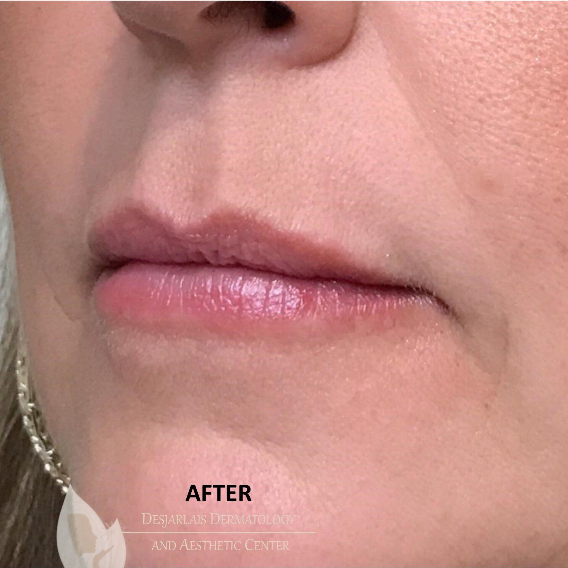 Lip Filler After Image at Dr. Desjarlais' Office in Adrian, MI