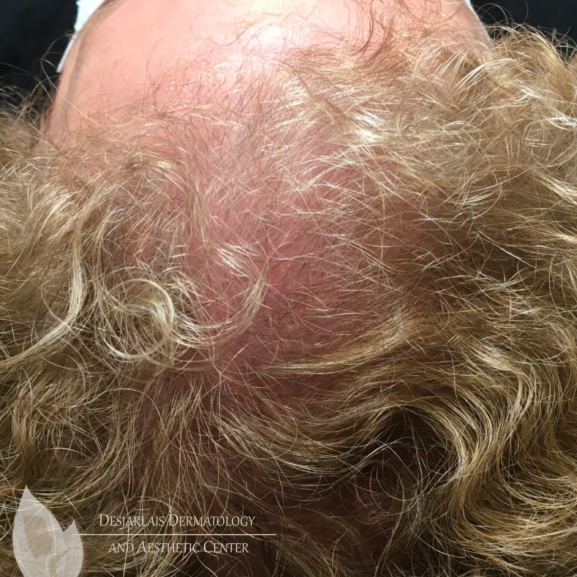 Keralase Hair Restoration Before Image at Dr. Desjarlais' Office in Adrian, MI