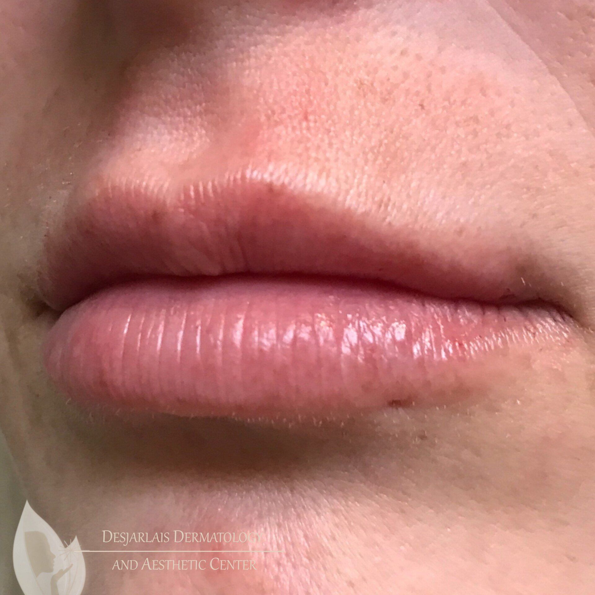Lip Filler After Image at Dr. Desjarlais' Office in Adrian, MI