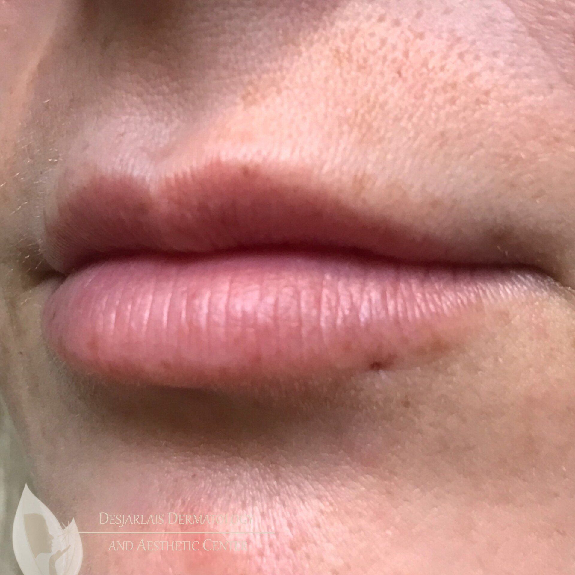 Lip Filler Before Image at Dr. Desjarlais' Office in Adrian, MI