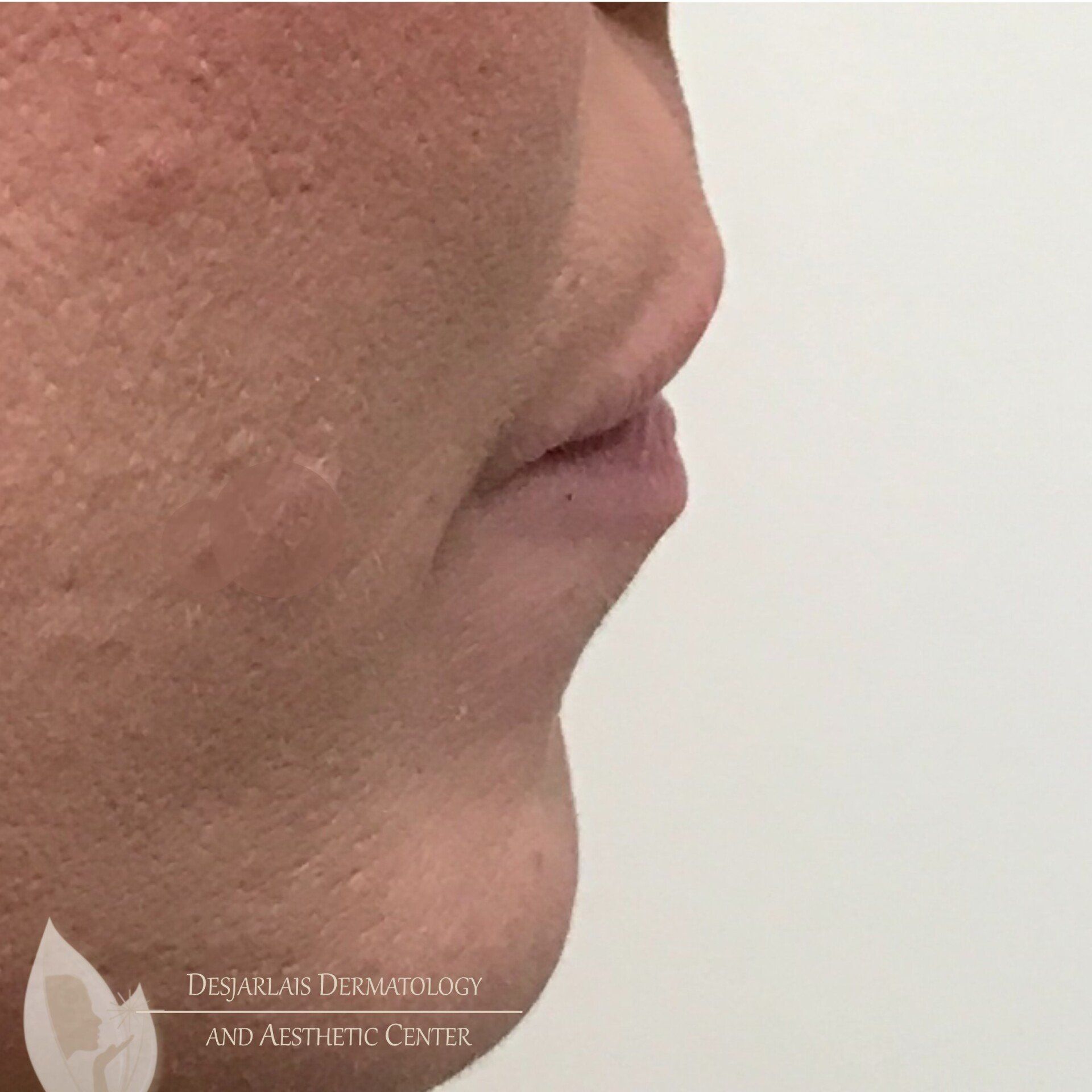 Lip Filler Before Image at Dr. Desjarlais' Office in Adrian, MI