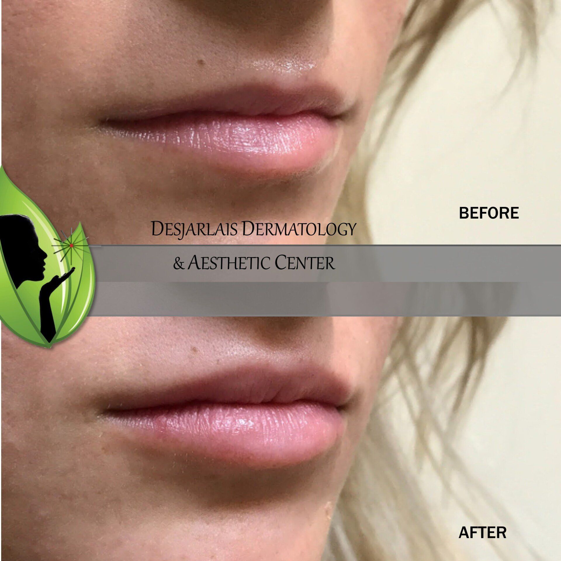 Restylane® Kysse Treatment at Desjarlais Dermatology in Adrian, MI
