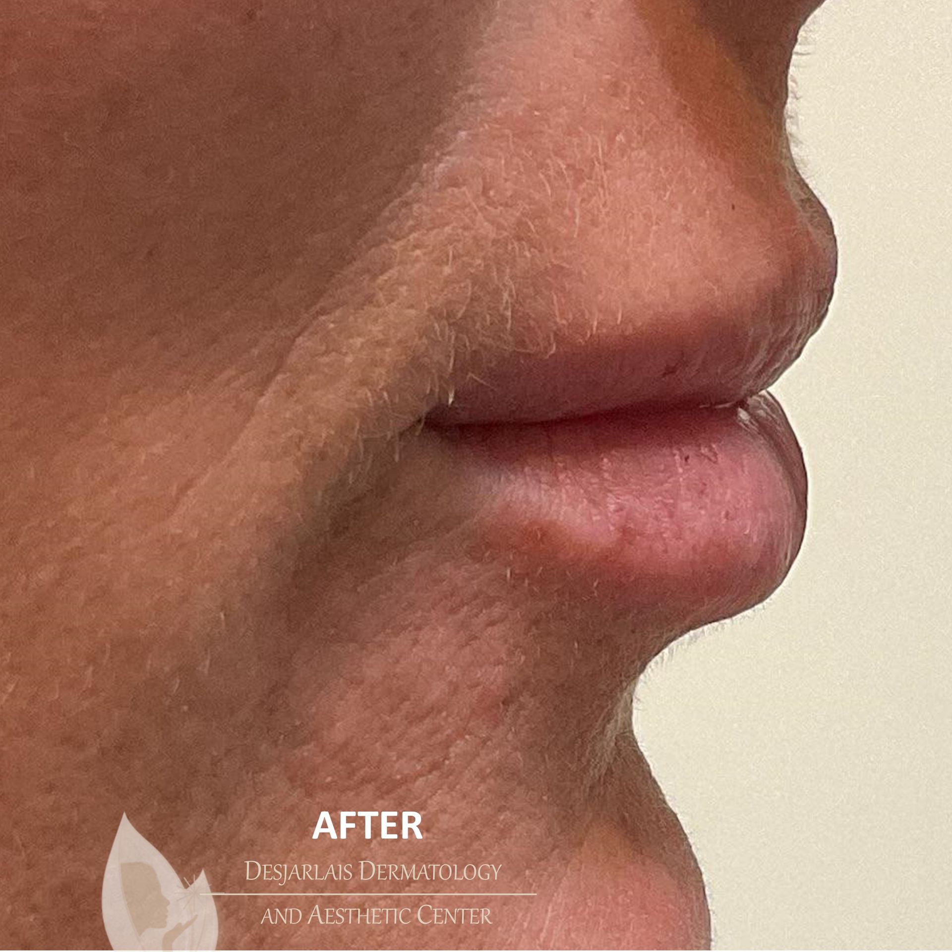 Lip Filler After Image at Dr. Desjarlais' Office in Adrian, MI