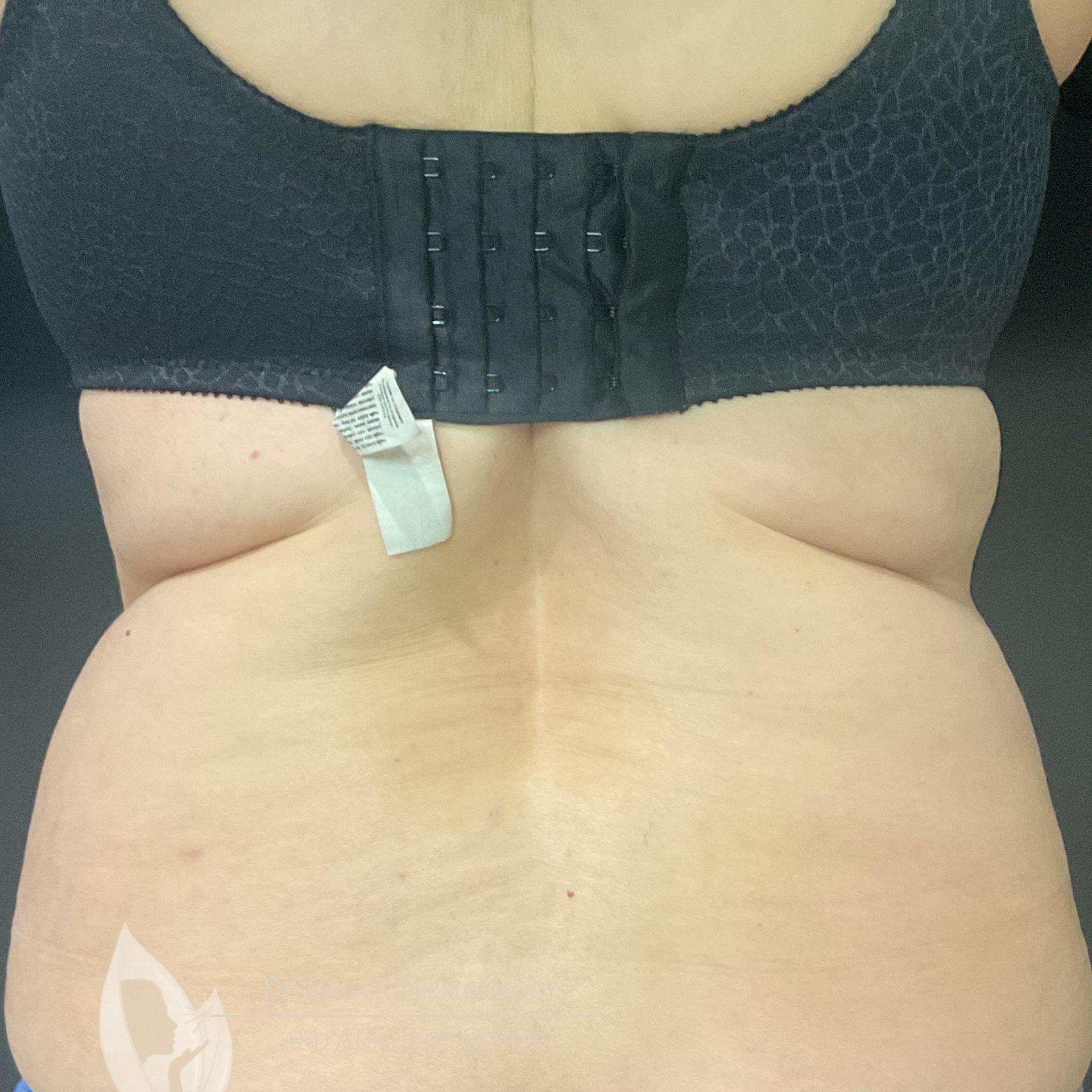 BodyTite Before Image at Dr. Desjarlais' Office in Adrian, MI