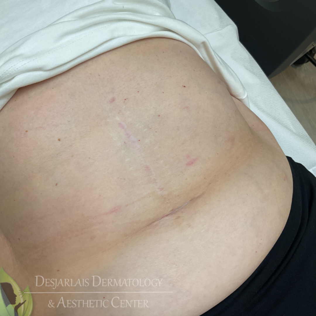 Scar Revision Treatment After Image at Dr. Desjarlais' Office in Adrian, MI