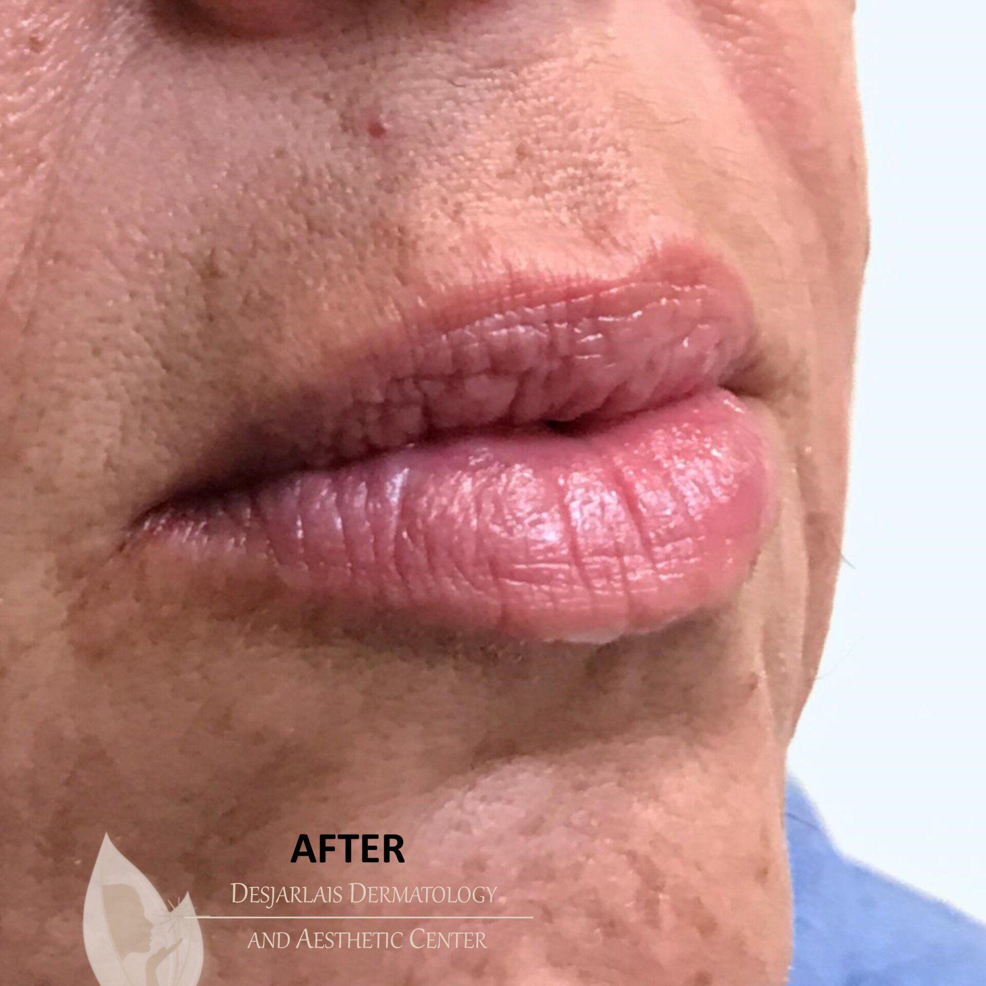 Lip Filler After Image at Dr. Desjarlais' Office in Adrian, MI