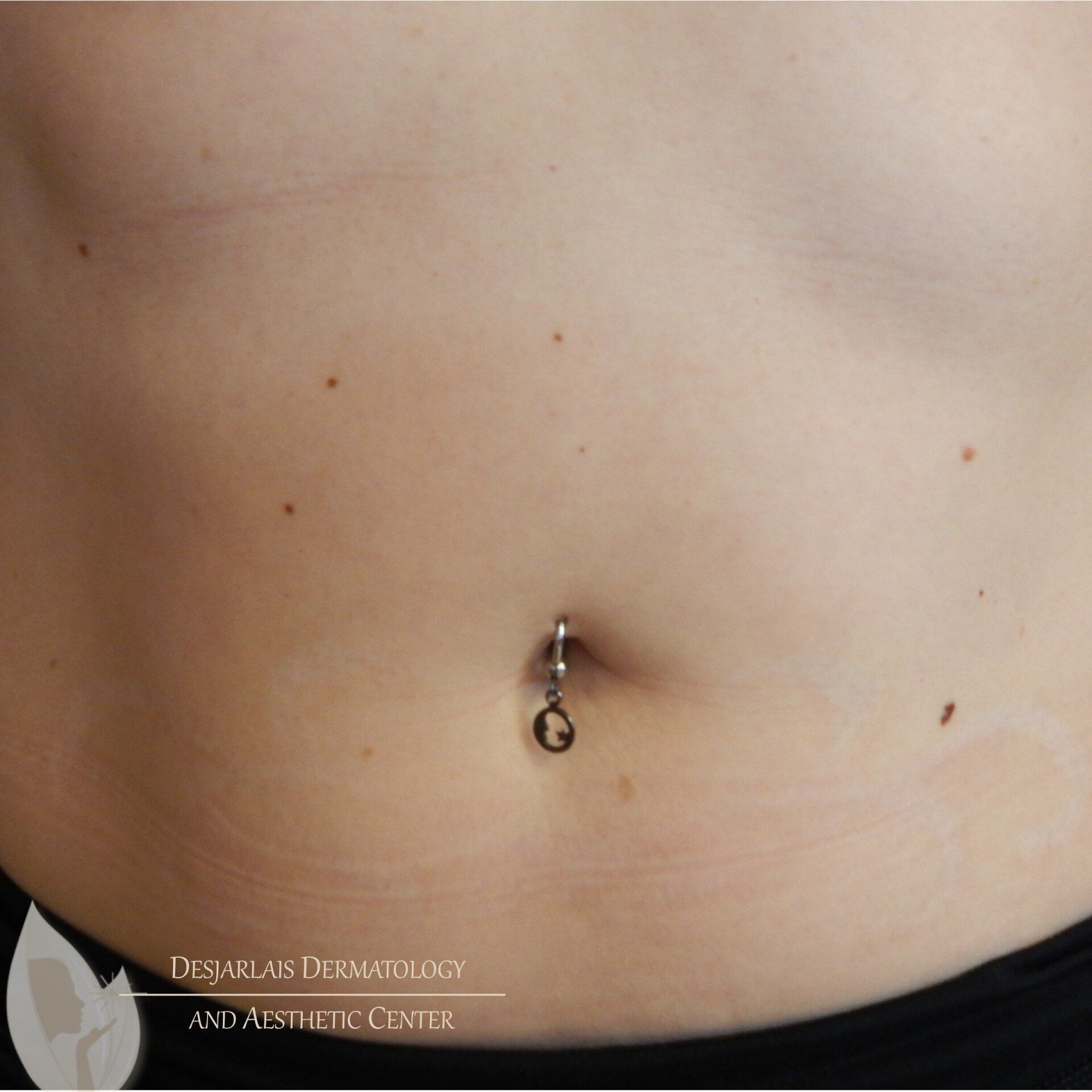 Tattoo Removal on Stomach After Image at Dr. Desjarlais' Office in Adrian, MI