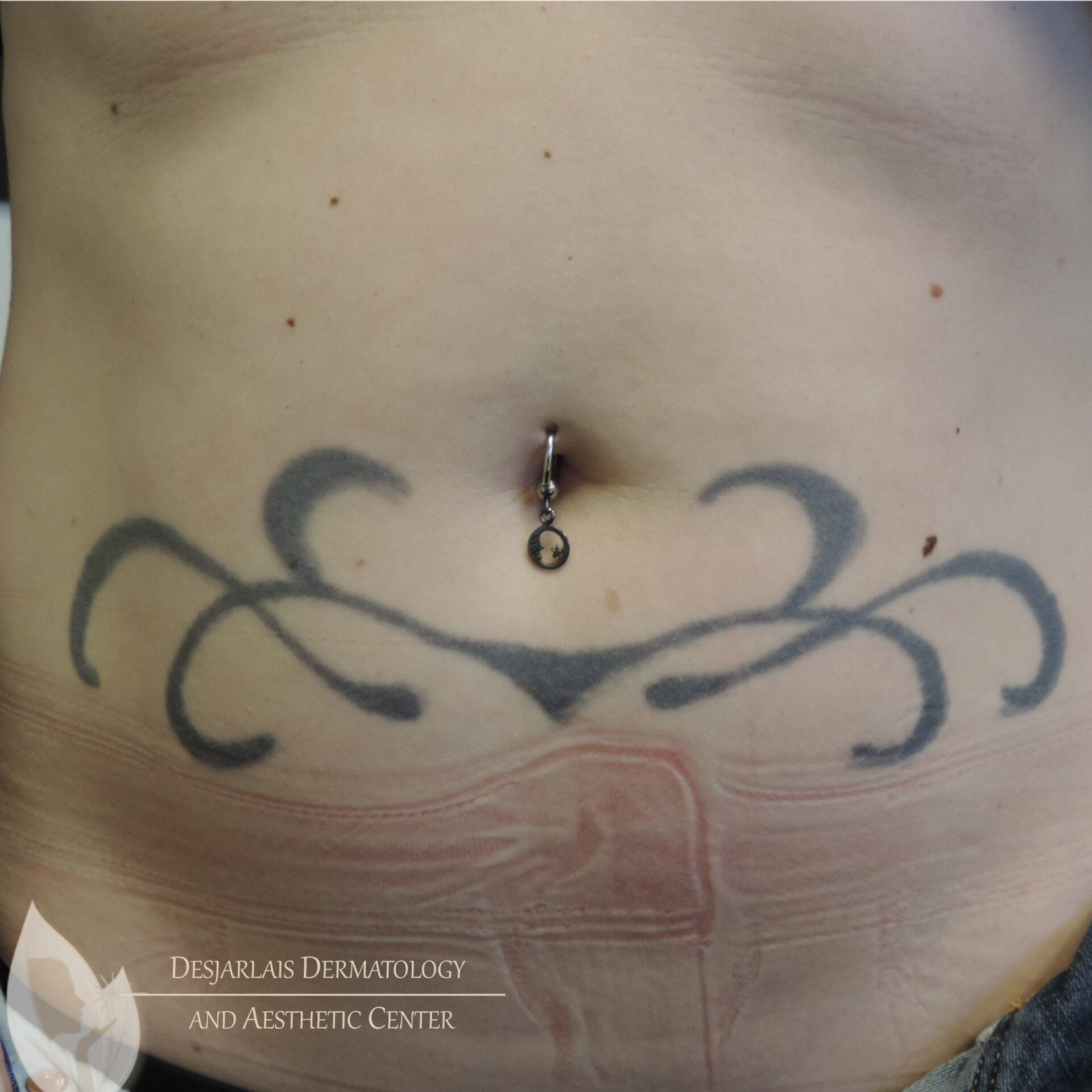 Tattoo Removal on Stomach Before Image at Dr. Desjarlais' Office in Adrian, MI