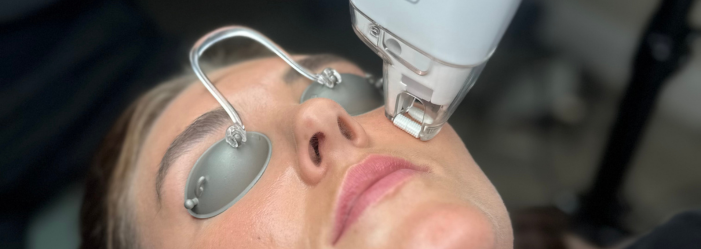 Collagen stimulations through cosmetic laser treatment