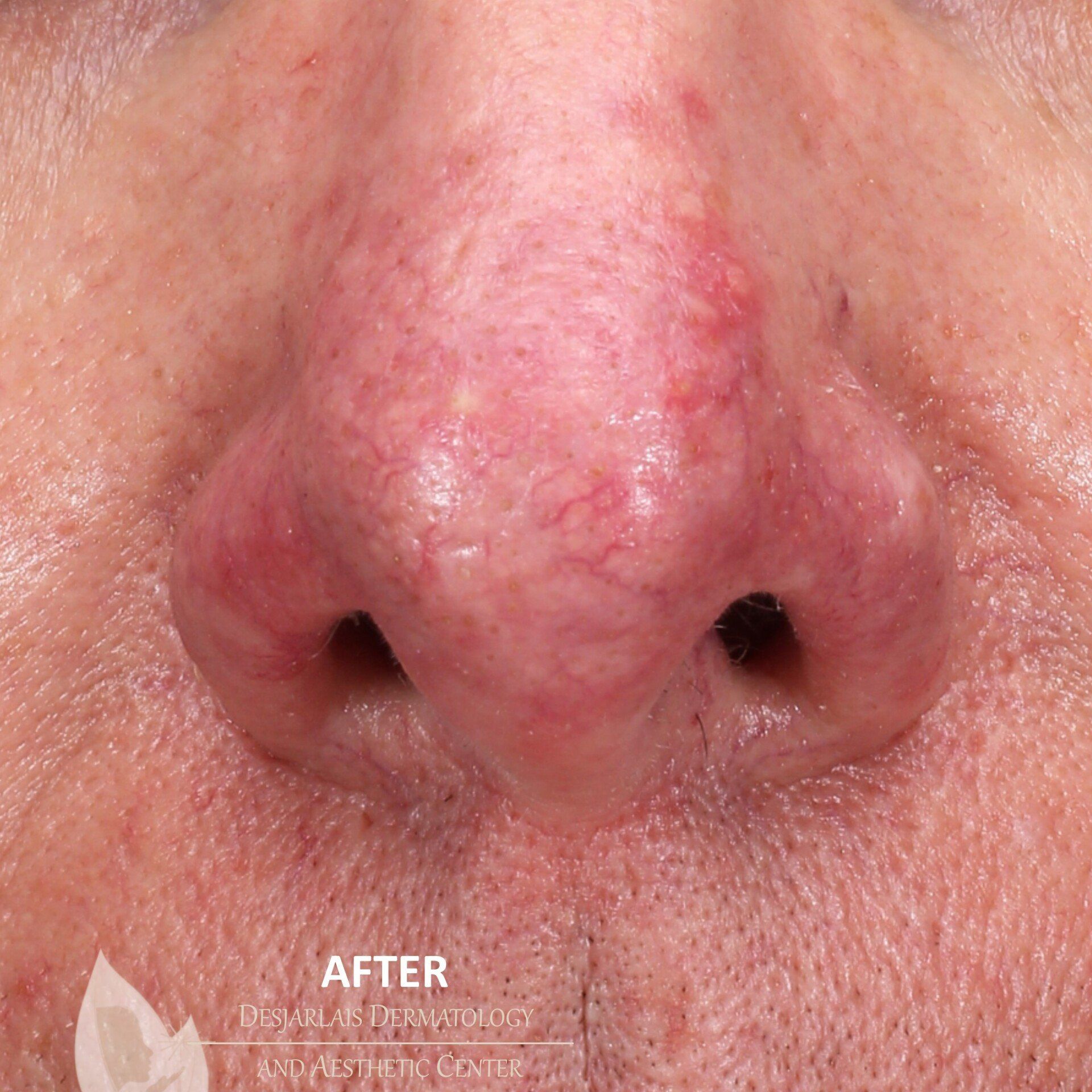 DermaV After Image at Dr. Desjarlais' Office in Adrian, MI