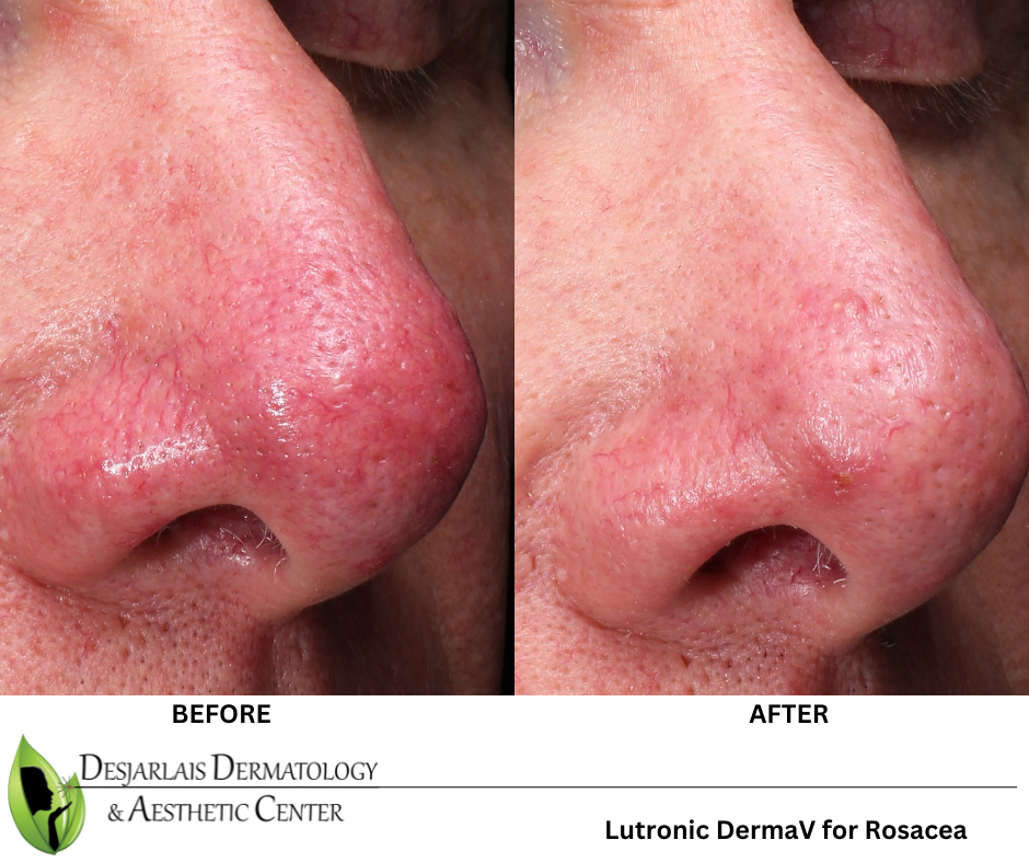 Before and After Image of Lutronic DermaV Patient