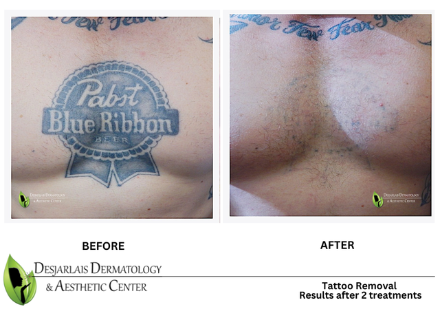 We Are The #1 Laser Tattoo Removal Clinic in Vancouver