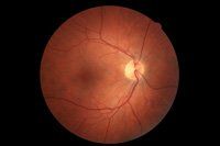 Right Eye - Result Of Right Eye Evaluation In Hamden, CT