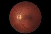 Left Eye - Result Of Left Eye Evaluation In Hamden, CT