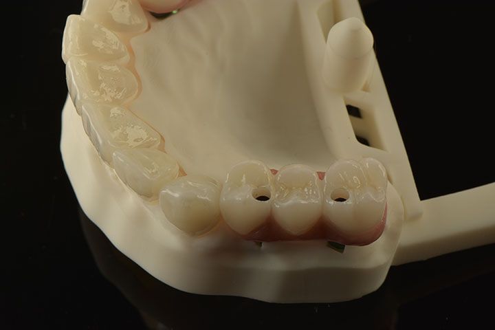 CLÍNICA MG IMPLANTES DENTALES