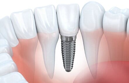 Guy with braces — Dental Implants in Banning, CA