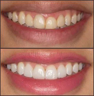 Before-and-after of a smile.