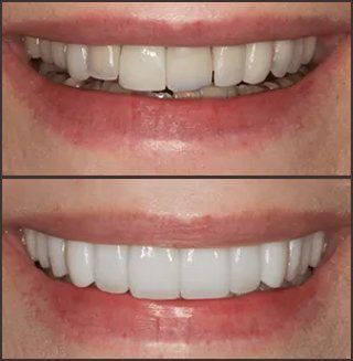 Before with chipped tooth and after with a complete, bright white smile.