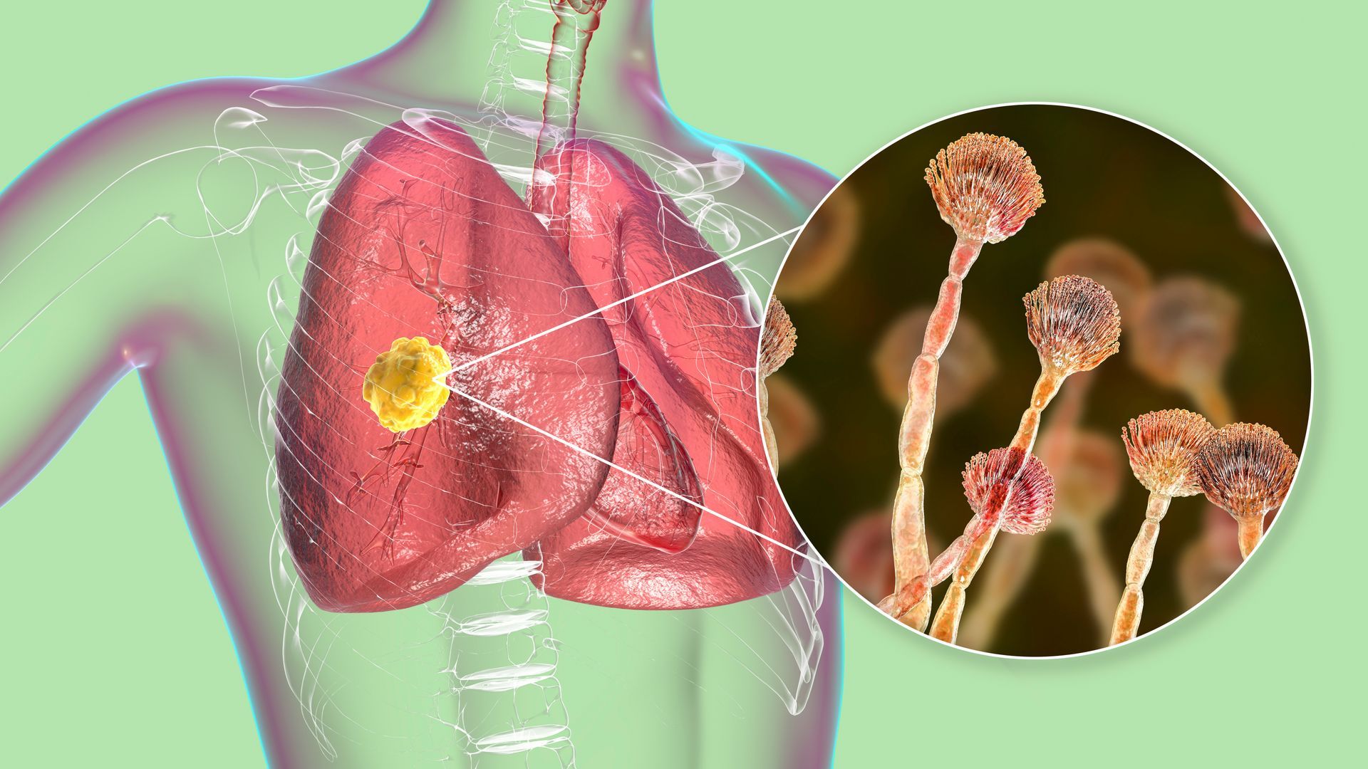 A close up of a person 's lungs with a picture of a fungus growing on them.