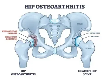 common-hip-injuries-treated-with-chiropractic-care-leander-tx