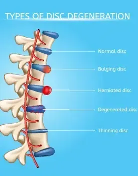 disc-injuries-treated-with-chiropractic-care-round-rock-tx