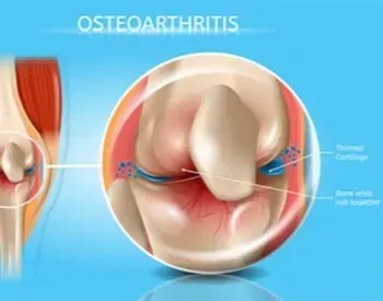 osteoarthritis